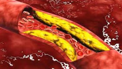 علامات خطيرة بالجسم تشير إلى ارتفاع الكوليسترول